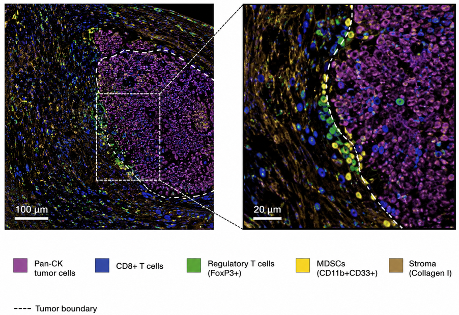 Multiplex tissue image and enlarged region showing Pan-CK tumor cells, CD8 T cells, regulatory T cells, myeloid-derived suppressor cells, collagen-rich stroma, and the tumor boundary.